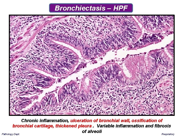 Bronchiectasis – HPF Chronic inflammation, ulceration of bronchial wall, ossification of bronchial cartilage, thickened