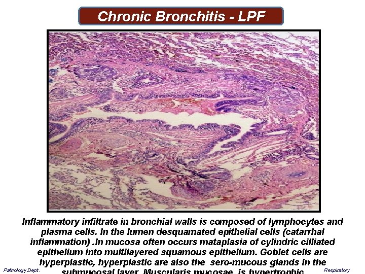 Chronic Bronchitis - LPF Inflammatory infiltrate in bronchial walls is composed of lymphocytes and