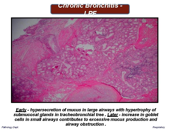 Chronic Bronchitis - LPF Early - hypersecretion of mucus in large airways with hypertrophy