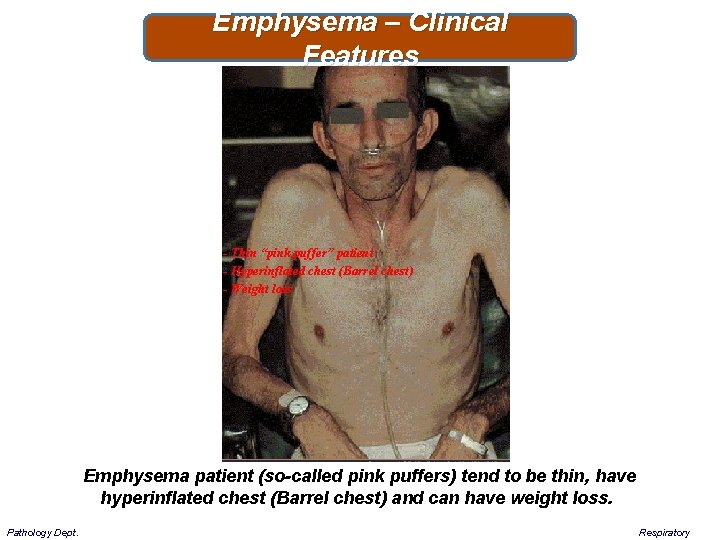 Emphysema – Clinical Features - Thin “pink puffer” patient - Hyperinflated chest (Barrel chest)