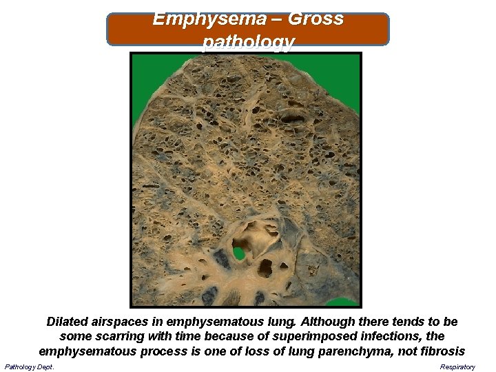 Emphysema – Gross pathology Dilated airspaces in emphysematous lung. Although there tends to be