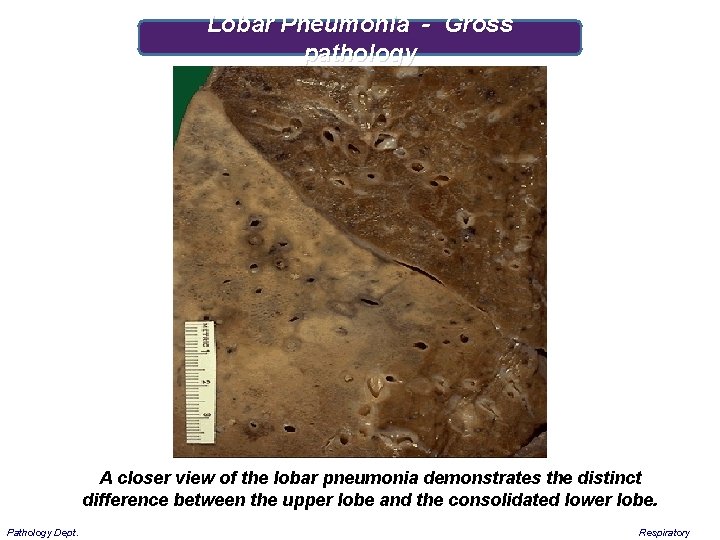 Lobar Pneumonia - Gross pathology A closer view of the lobar pneumonia demonstrates the