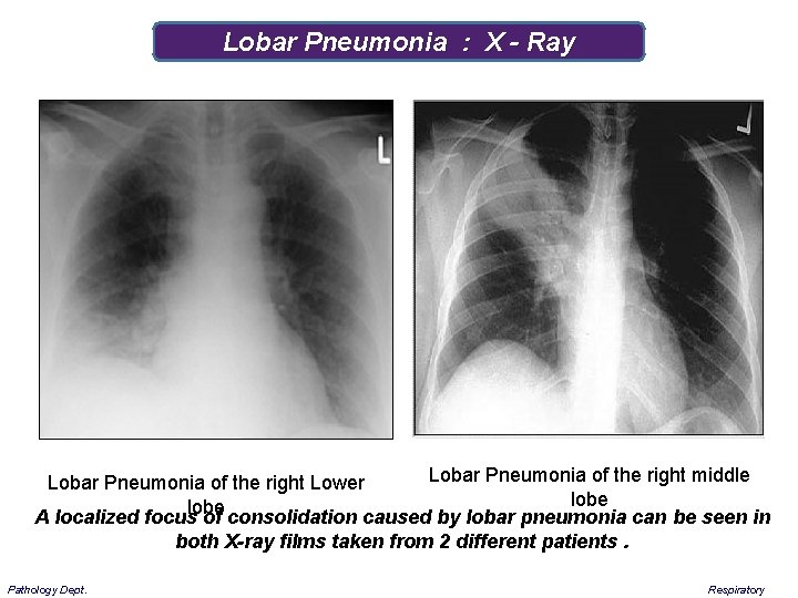 Lobar Pneumonia : X - Ray Lobar Pneumonia of the right middle Lobar Pneumonia