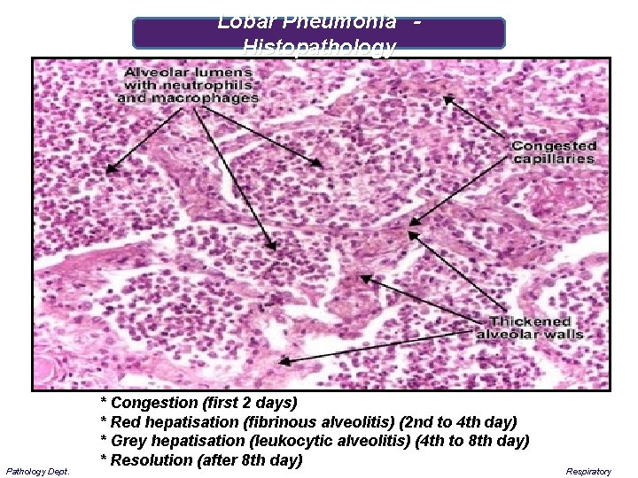 Lobar Pneumonia - Histopathology Pathology Dept. * Congestion (first 2 days) * Red hepatisation