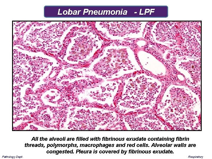 Lobar Pneumonia - LPF All the alveoli are filled with fibrinous exudate containing fibrin