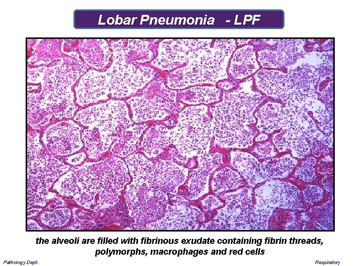 Lobar Pneumonia - LPF the alveoli are filled with fibrinous exudate containing fibrin threads,