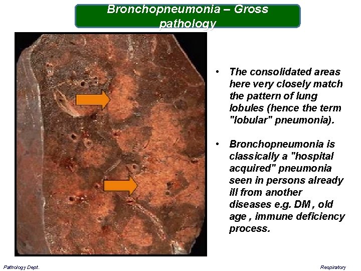 Bronchopneumonia – Gross pathology • The consolidated areas here very closely match the pattern