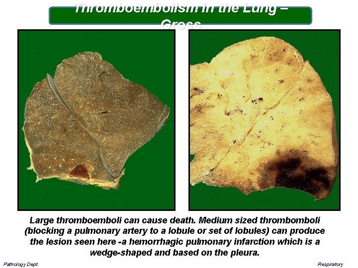 Thromboembolism in the Lung – Gross Large thromboemboli can cause death. Medium sized thrombomboli
