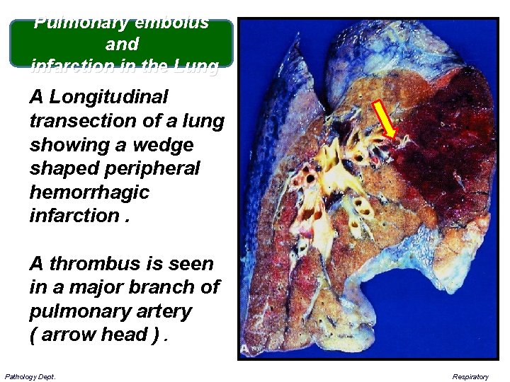 Pulmonary embolus and infarction in the Lung A Longitudinal transection of a lung showing