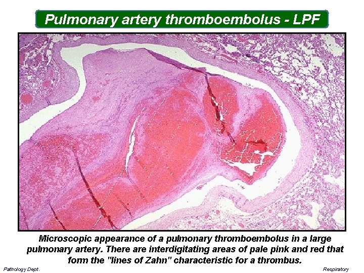 Pulmonary artery thromboembolus - LPF Microscopic appearance of a pulmonary thromboembolus in a large