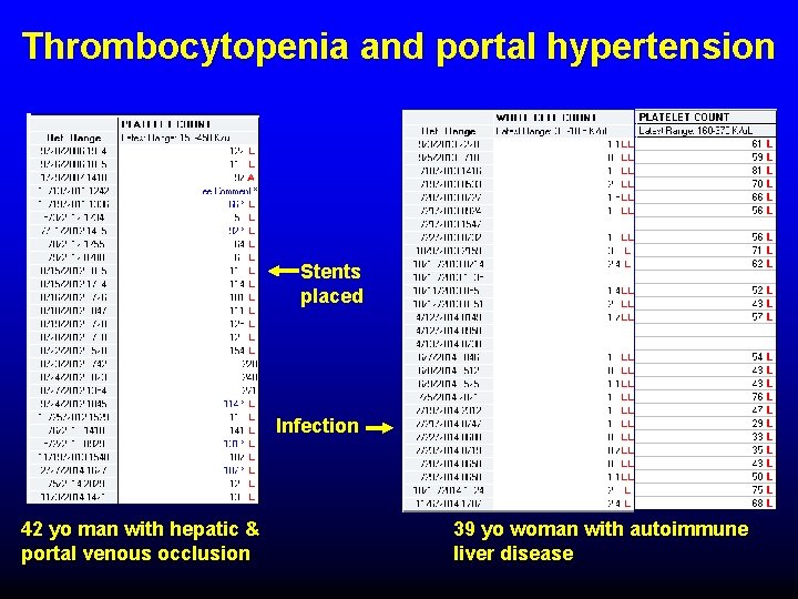 Thrombocytopenia and portal hypertension Stents placed Infection 42 yo man with hepatic & portal