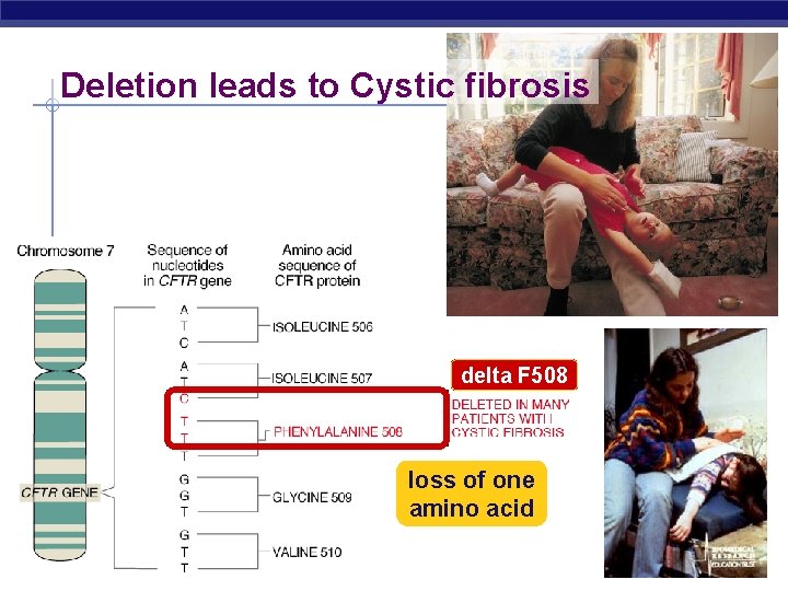 Deletion leads to Cystic fibrosis delta F 508 loss of one amino acid AP