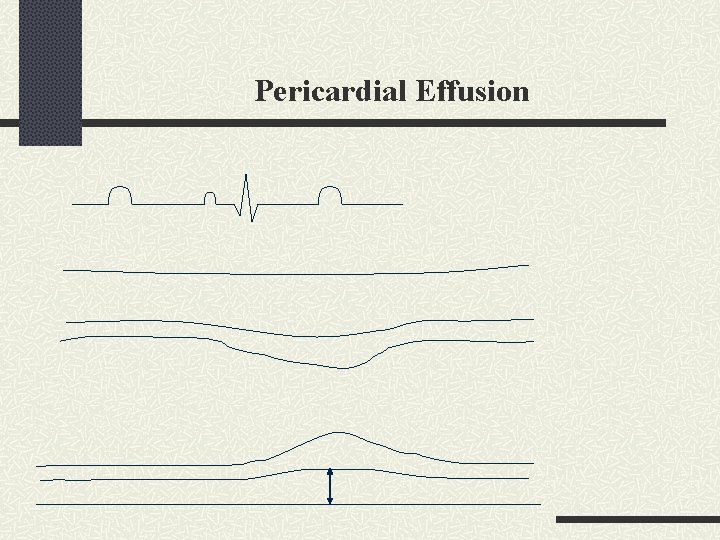 Pericardial Effusion 