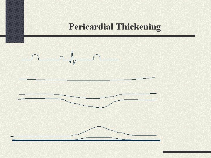Pericardial Thickening 