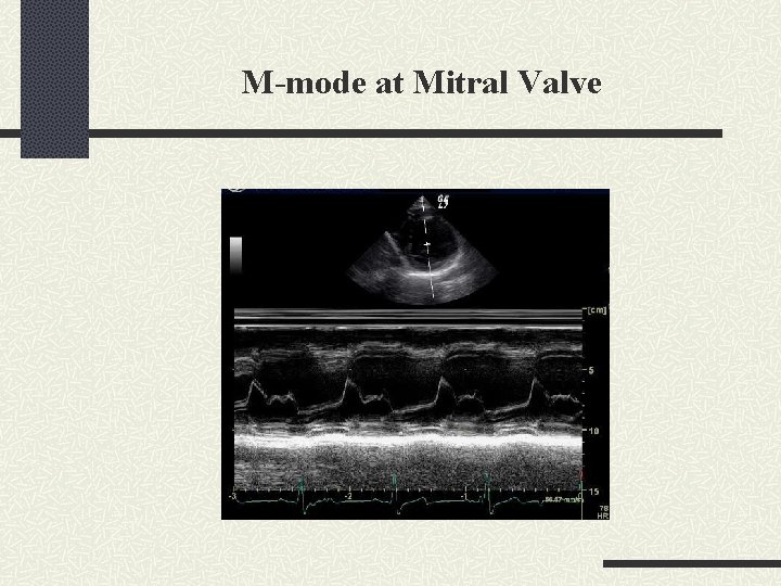 M-mode at Mitral Valve 