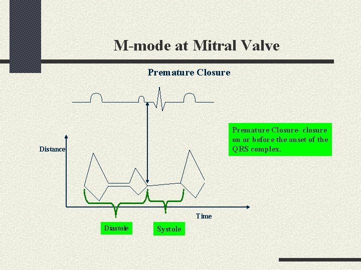 M-mode at Mitral Valve Premature Closure- closure on or before the onset of the