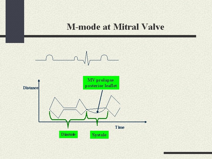 M-mode at Mitral Valve MV prolapse posterior leaflet Distance Time Diastole Systole 