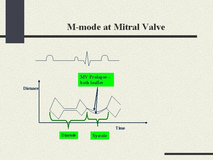 M-mode at Mitral Valve MV Prolapse – both leaflet Distance Time Diastole Systole 