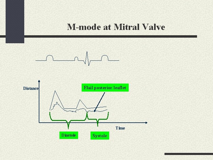 M-mode at Mitral Valve Flail posterior leaflet Distance Time Diastole Systole 