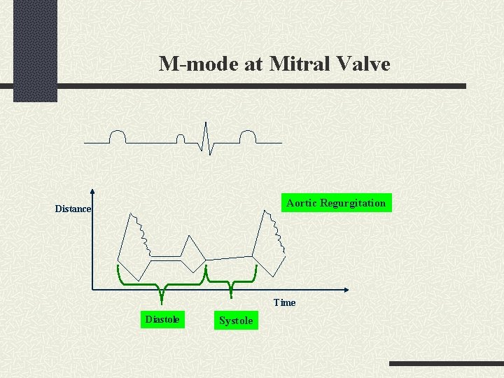 M-mode at Mitral Valve Aortic Regurgitation Distance Time Diastole Systole 