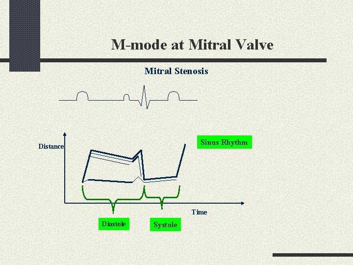 M-mode at Mitral Valve Mitral Stenosis Sinus Rhythm Distance Time Diastole Systole 