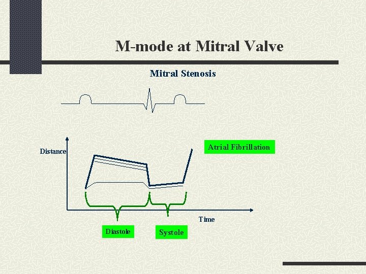 M-mode at Mitral Valve Mitral Stenosis Atrial Fibrillation Distance Time Diastole Systole 