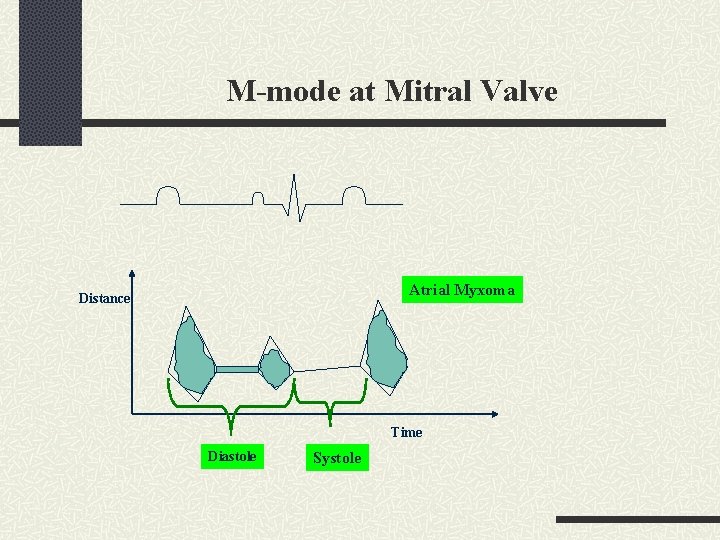 M-mode at Mitral Valve Atrial Myxoma Distance Time Diastole Systole 