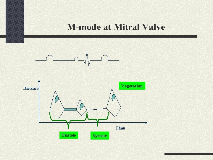 M-mode at Mitral Valve Vegetation Distance Time Diastole Systole 
