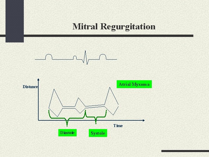 Mitral Regurgitation Atrial Myxoma Distance Time Diastole Systole 