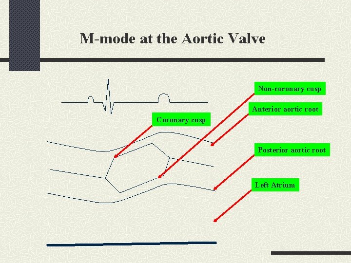 M-mode at the Aortic Valve Non-coronary cusp Anterior aortic root Coronary cusp Posterior aortic