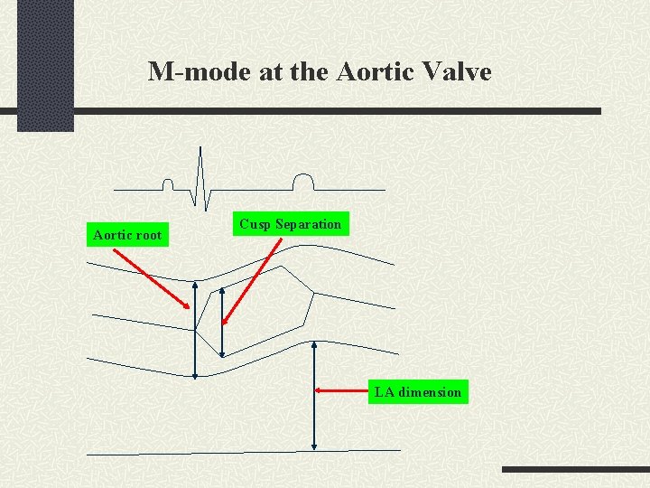 M-mode at the Aortic Valve Aortic root Cusp Separation LA dimension 