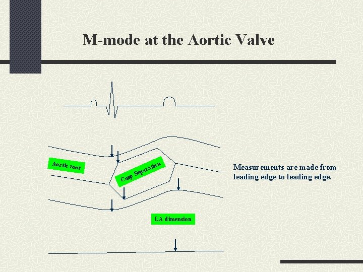 M-mode at the Aortic Valve Aortic ro ot tion ra epa C S usp