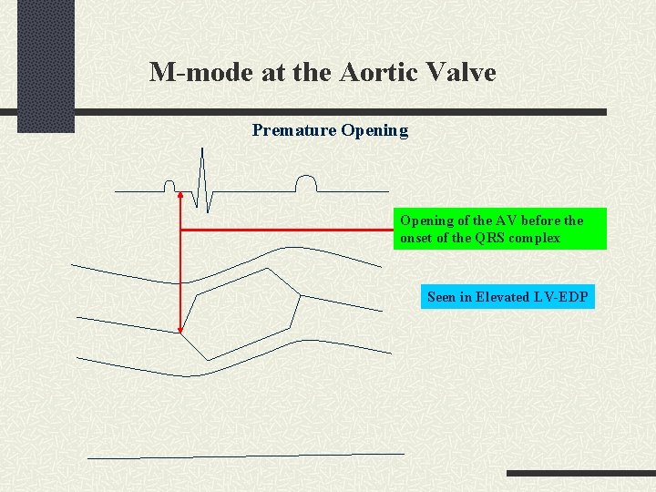 M-mode at the Aortic Valve Premature Opening of the AV before the onset of
