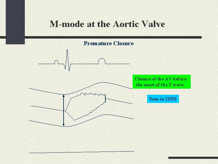 M-mode at the Aortic Valve Premature Closure of the AV before the onset of