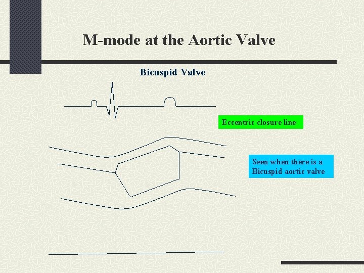 M-mode at the Aortic Valve Bicuspid Valve Eccentric closure line Seen when there is