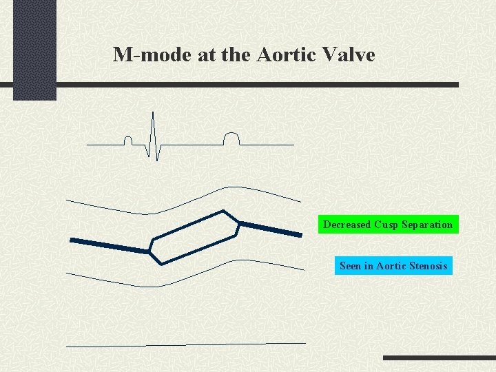 M-mode at the Aortic Valve Decreased Cusp Separation Seen in Aortic Stenosis 