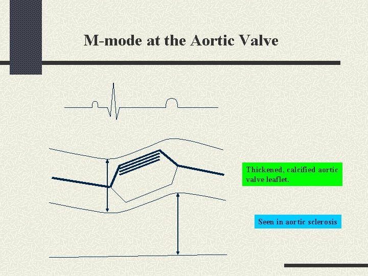 M-mode at the Aortic Valve Thickened, calcified aortic valve leaflet. Seen in aortic sclerosis