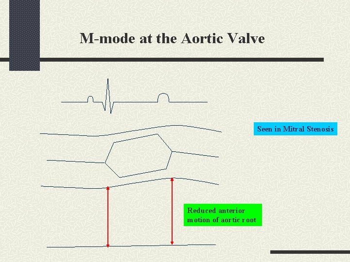 M-mode at the Aortic Valve Seen in Mitral Stenosis Reduced anterior motion of aortic