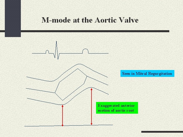 M-mode at the Aortic Valve Seen in Mitral Regurgitation Exaggerated anterior motion of aortic