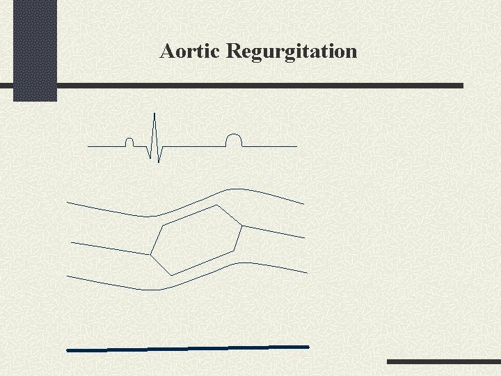 Aortic Regurgitation 