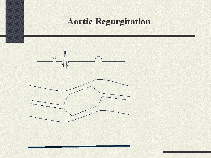 Aortic Regurgitation 