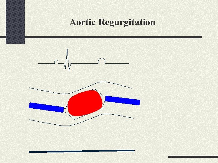Aortic Regurgitation 
