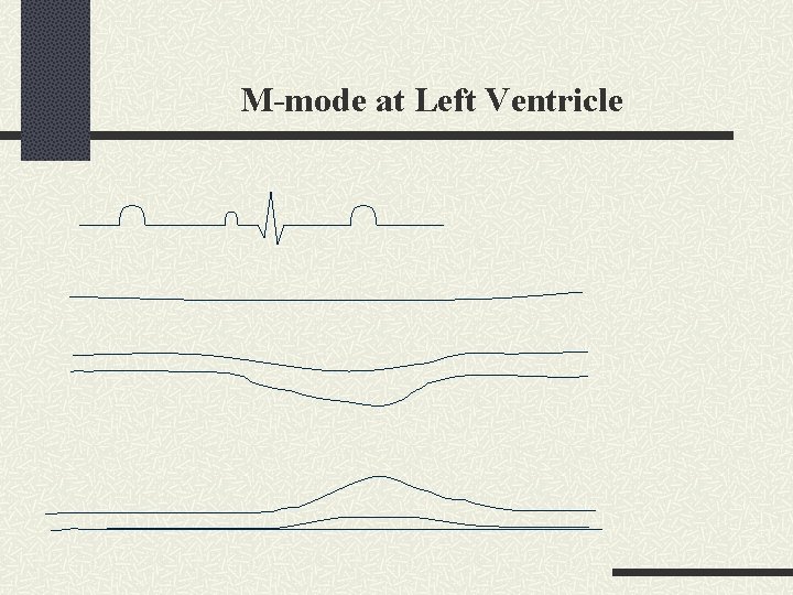 M-mode at Left Ventricle 