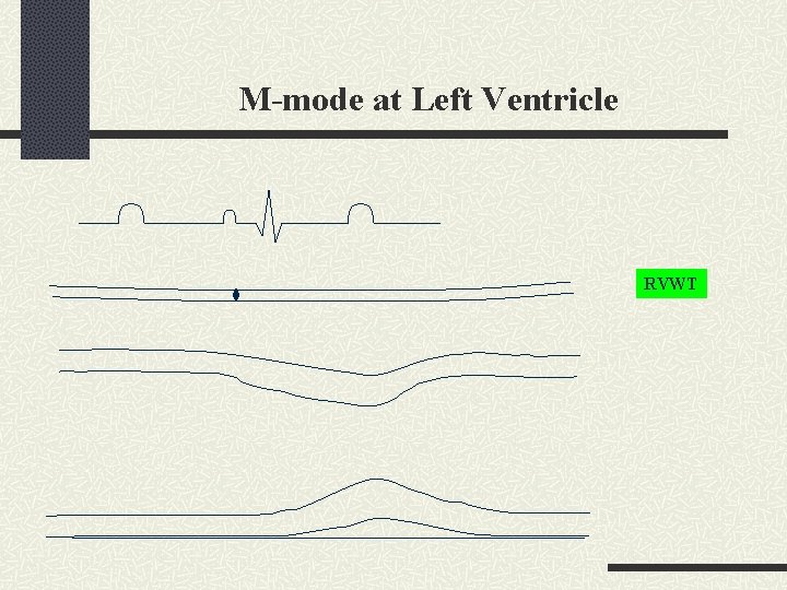 M-mode at Left Ventricle RVWT 
