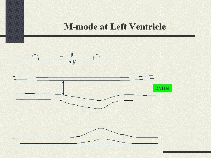 M-mode at Left Ventricle RVIDd 