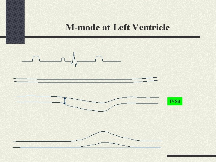 M-mode at Left Ventricle IVSd 
