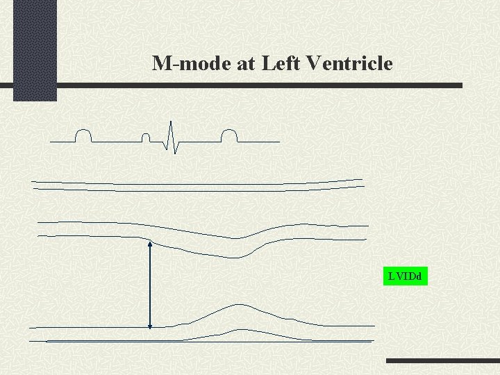 M-mode at Left Ventricle LVIDd 