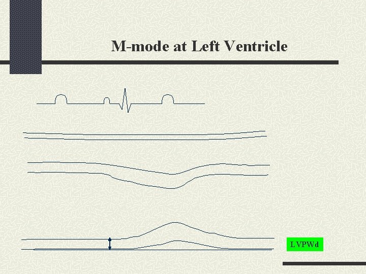 M-mode at Left Ventricle LVPWd 