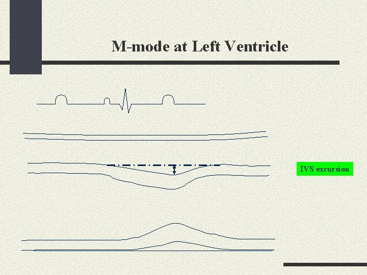 M-mode at Left Ventricle IVS excursion 