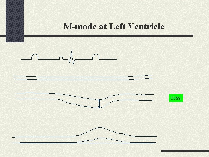 M-mode at Left Ventricle IVSs 